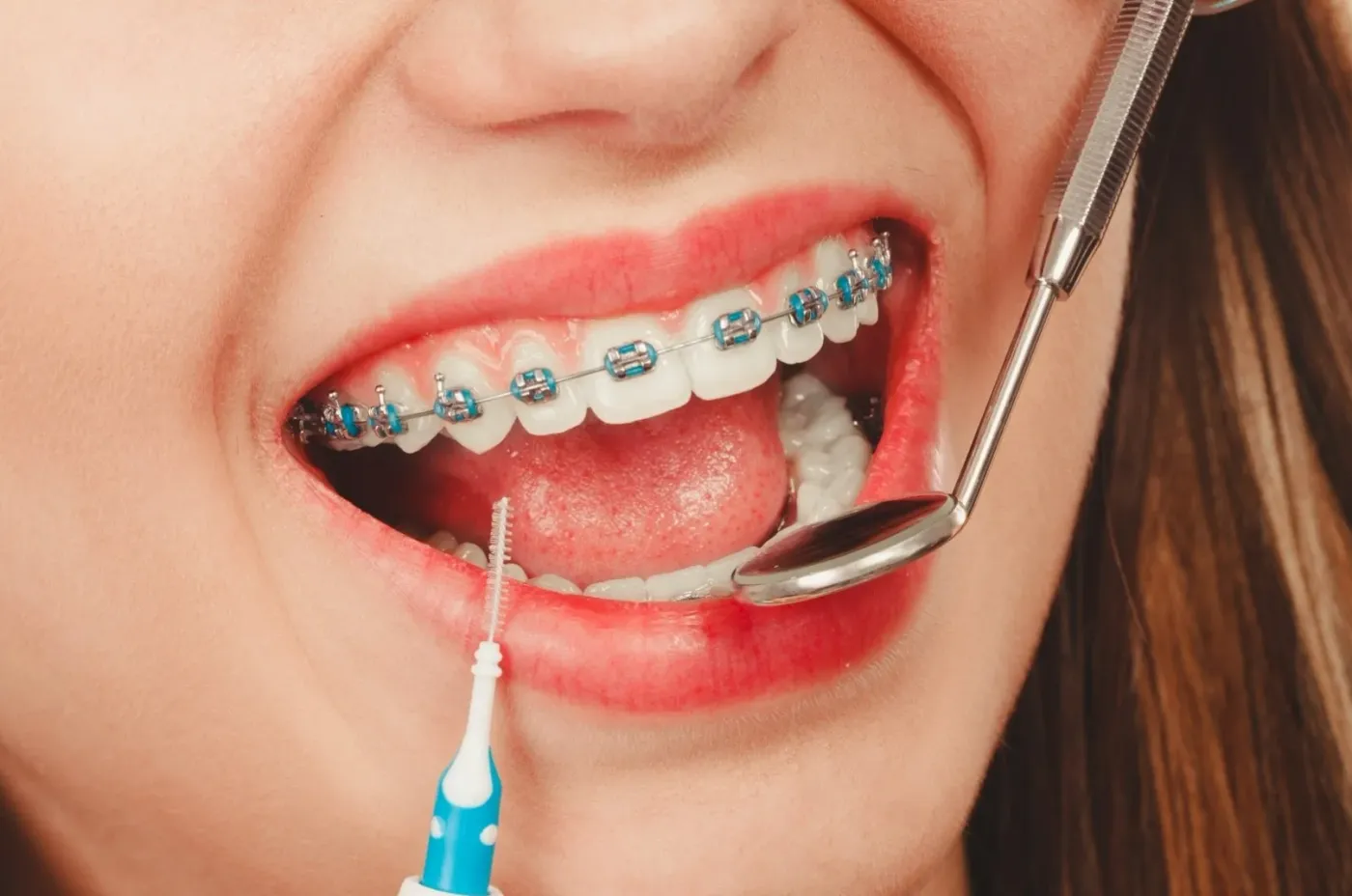 Close-up of a smile with braces during an orthodontic check-up